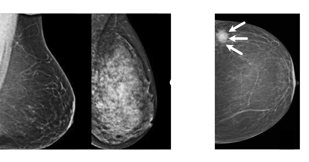 Mammographic density comparison showing different breast tissue densities
